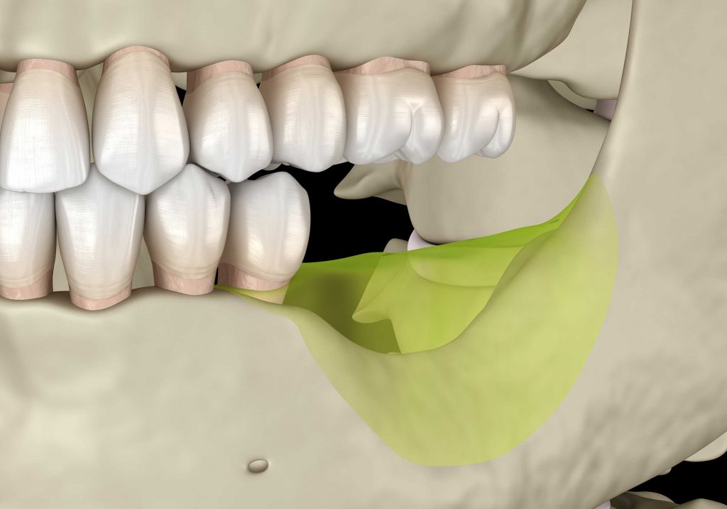 Implantes dentales con poco hueso