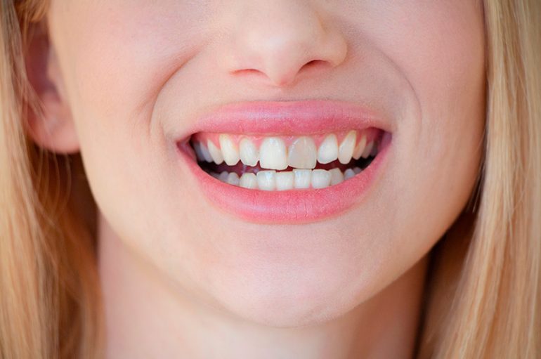 sonrisa de mujer con diente descolorido