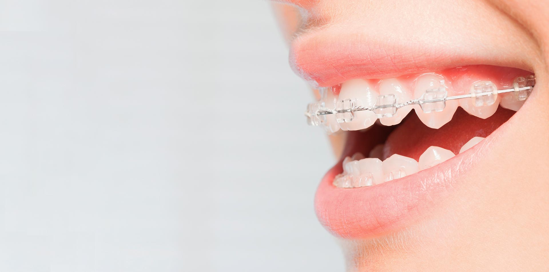 Brackets Estéticos en Palma de Mallorca Clínica Dental Fàbregues
