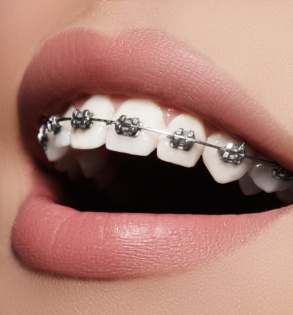 sonrisa de mujer con brackets tradicionales