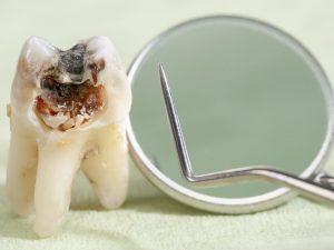 ¿Cómo eliminar las caries?