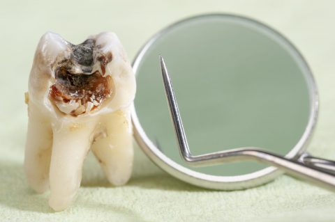 Representación de una muela afectada por las caries junto a instrumental para eliminarla