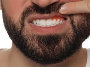 ¿Cómo se cura la periodontitis?