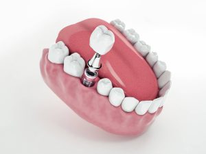 ¿Cómo se pone un implante dental?