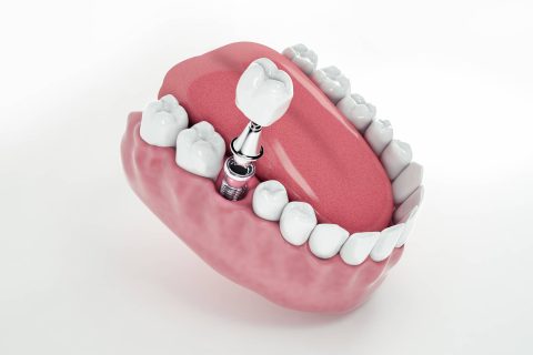 maqueta de como se pone un implante dental