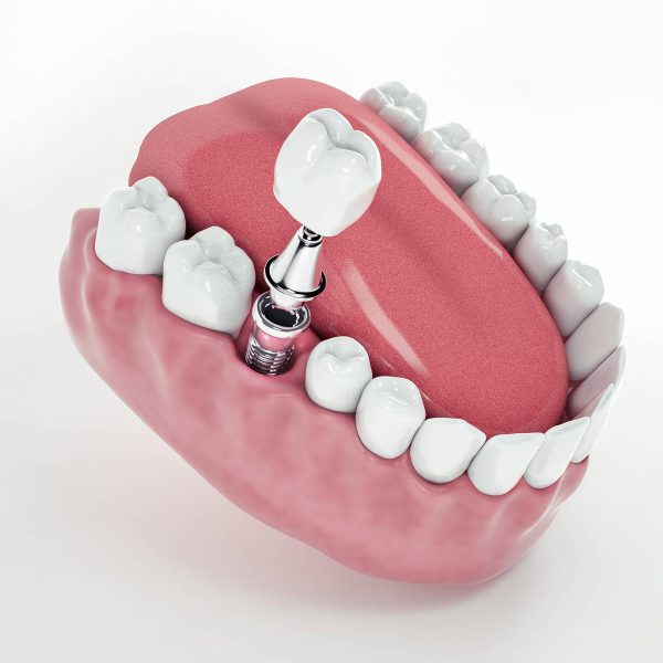maqueta de como se pone un implante dental