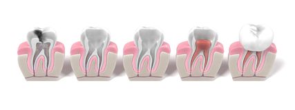 Evolución y realización de una Endodoncia