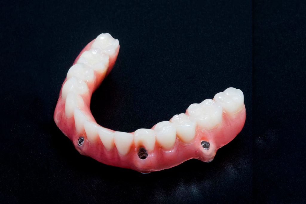 Implantes dentales para desdentados