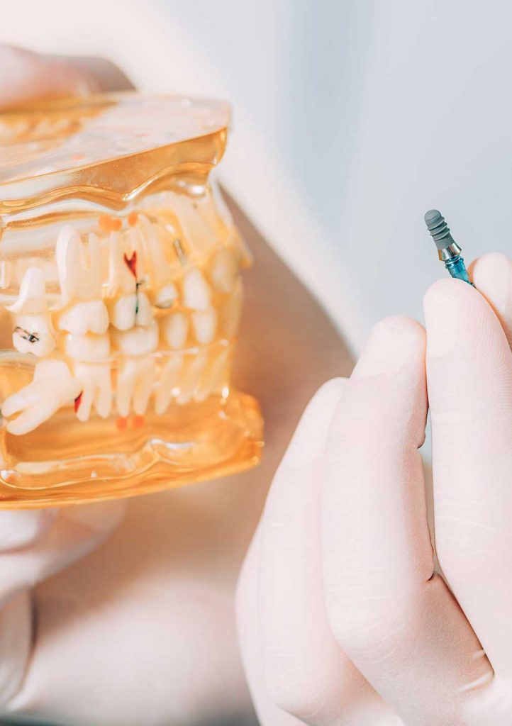 Implantes dentales con poco hueso