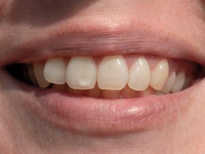 ¿Cómo eliminar las manchas blancas en los dientes?