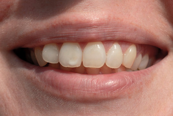 Mujer con manchas blancas en los dientes
