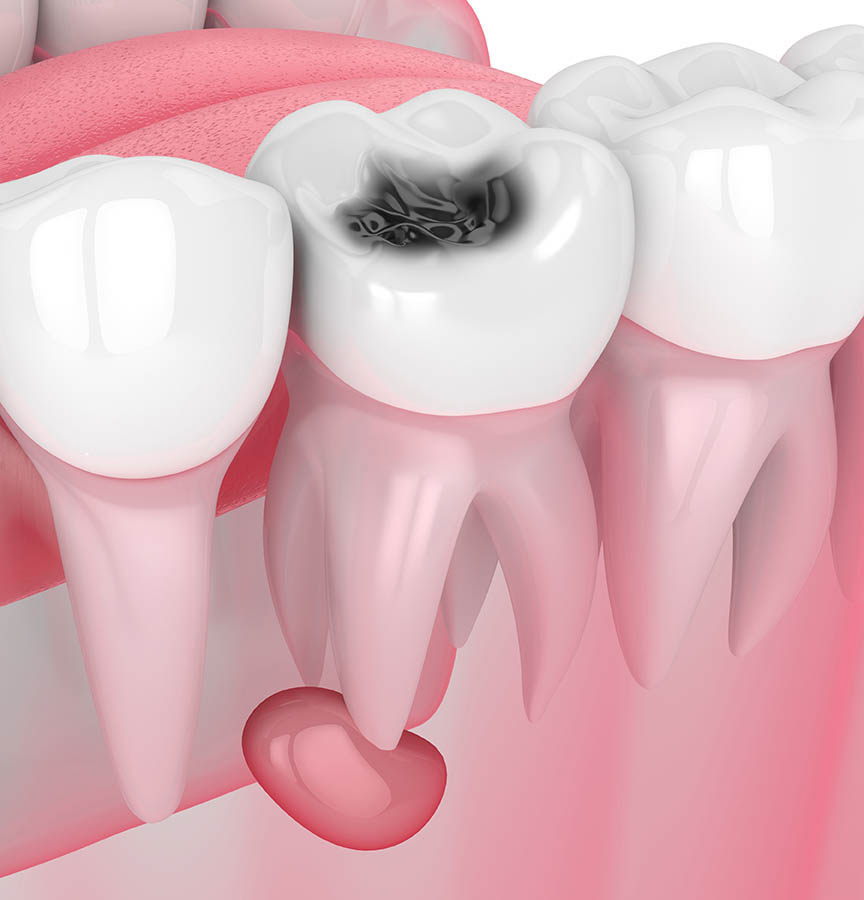 Salud dental - Apicectomía