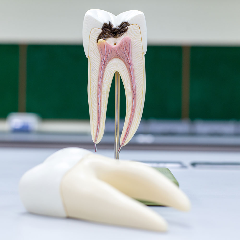 maqueta de diente con caries