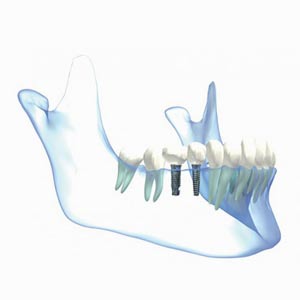 tratamiento-implantes-dentales