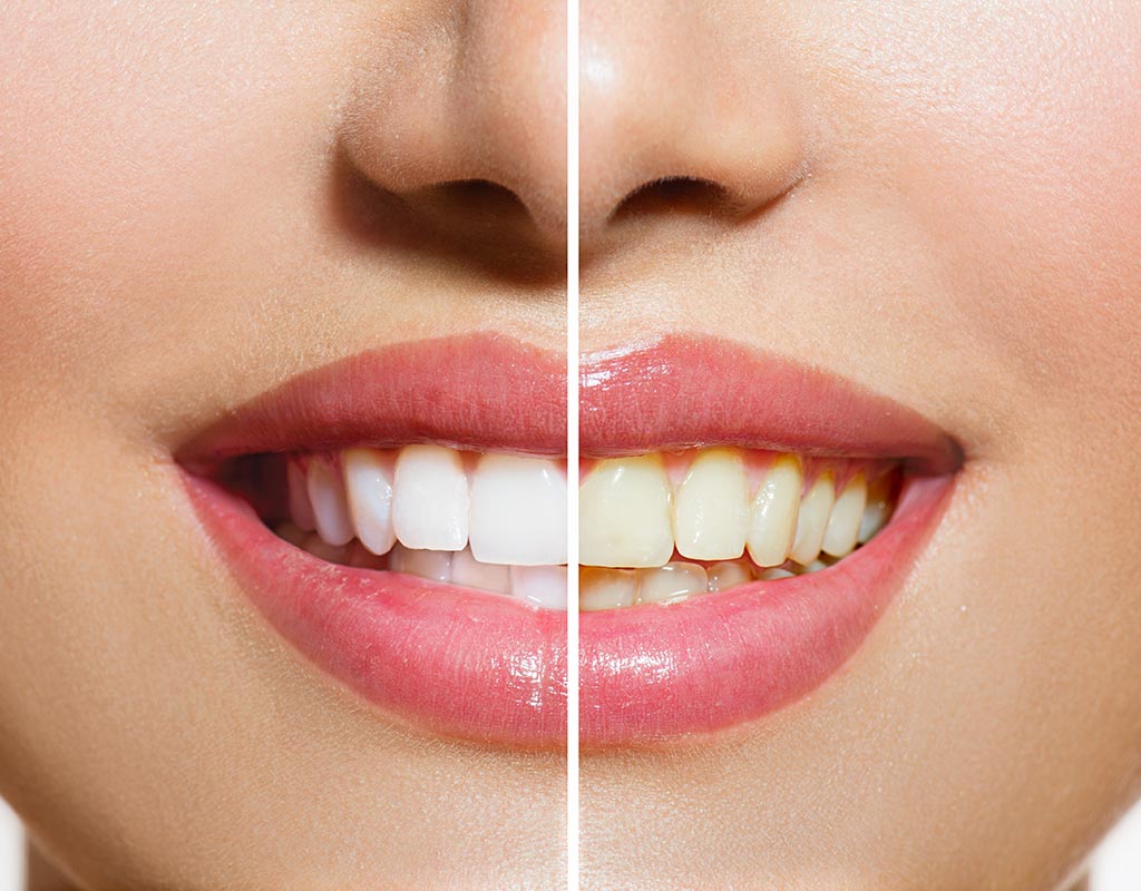 antes y después de tratamiento de blanqueamiento dental