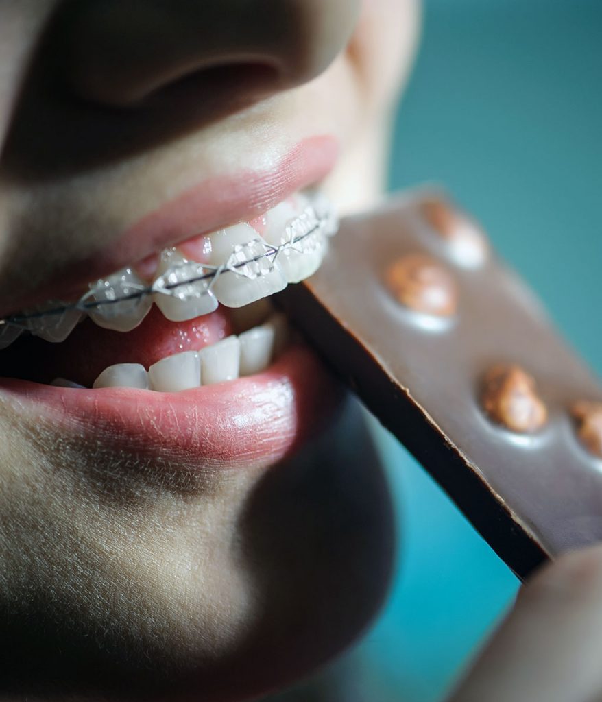 brackets estéticos en sonrisa de mujer