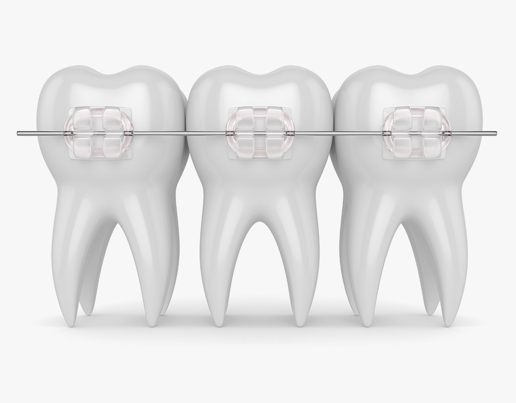 maqueta 3D de brackets estéticos