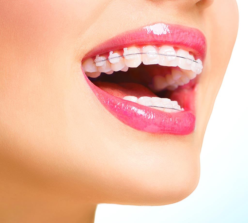 sonrisa de mujer con tratamiento de brackets estéticos