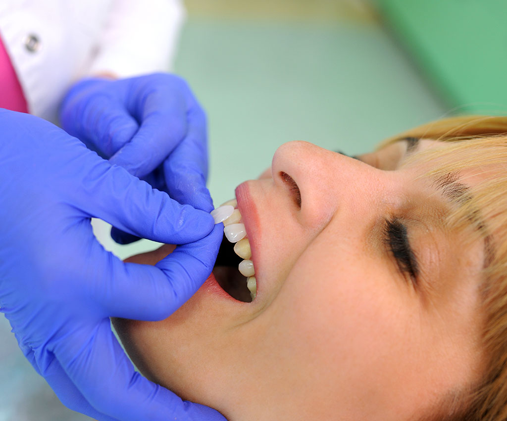 carillas dentales siendo colocadas en paciente