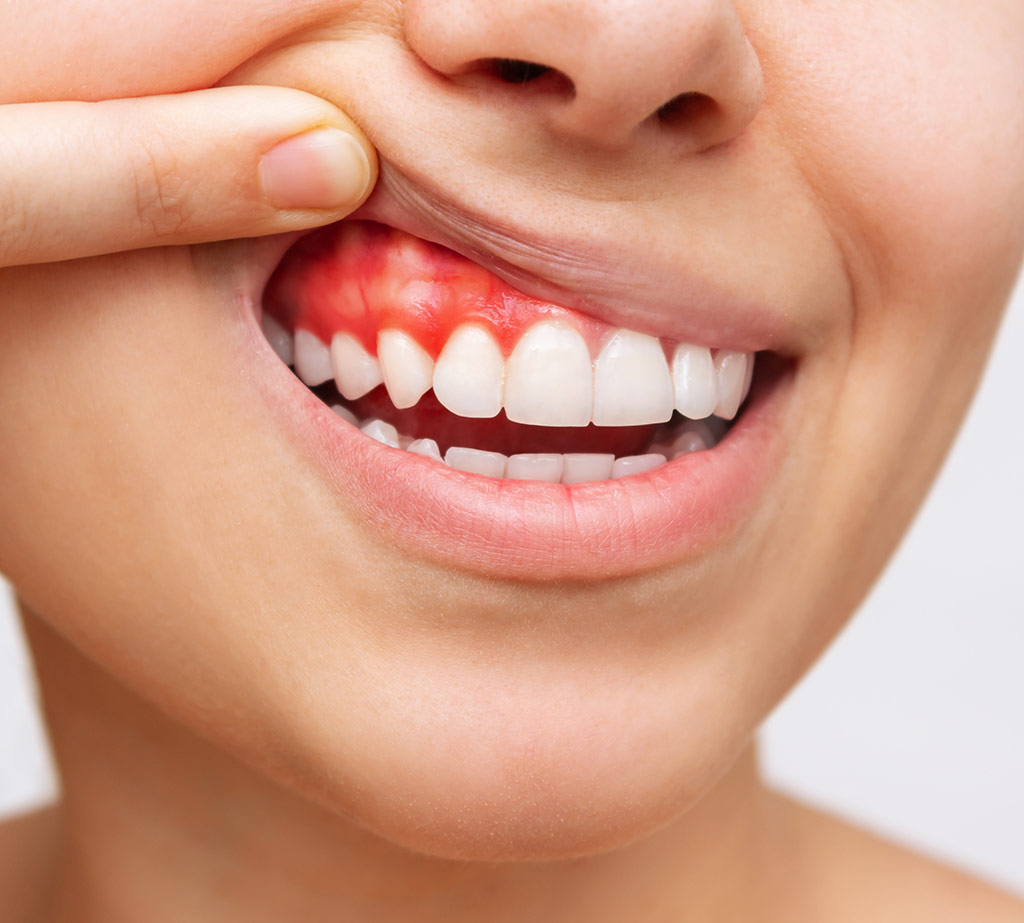 mujer levantando el labio de la encía