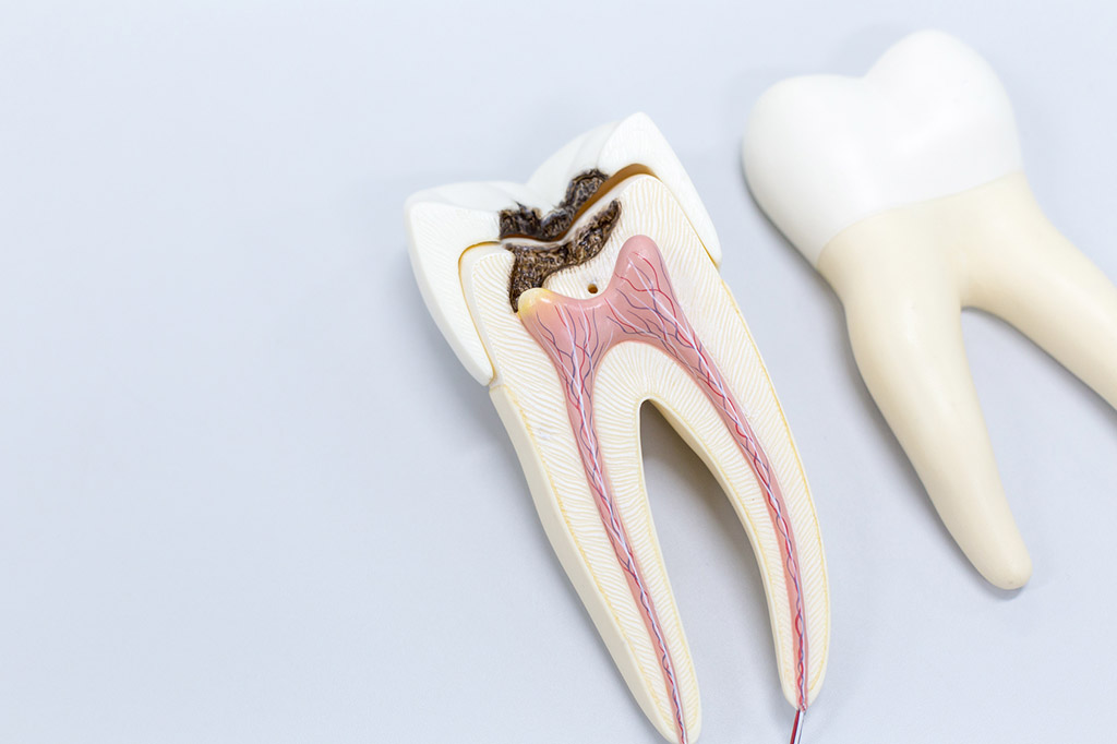maqueta del interior de un diente afectado por caries y pulpitis