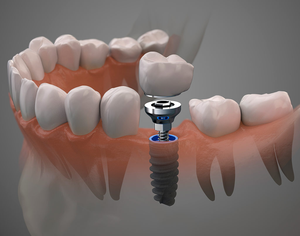 maqueta 3D de la colocación en la boca de un paciente de un implante dental
