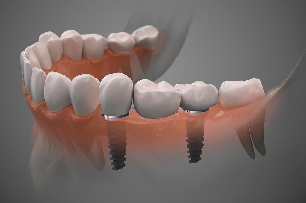maqueta digital de implantes colocados en la boca