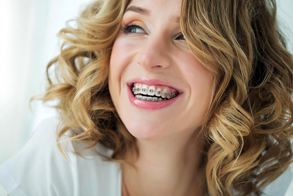 mujer adulta sonriendo con brackets tradicionales