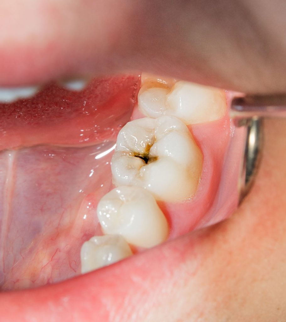 diente con caries